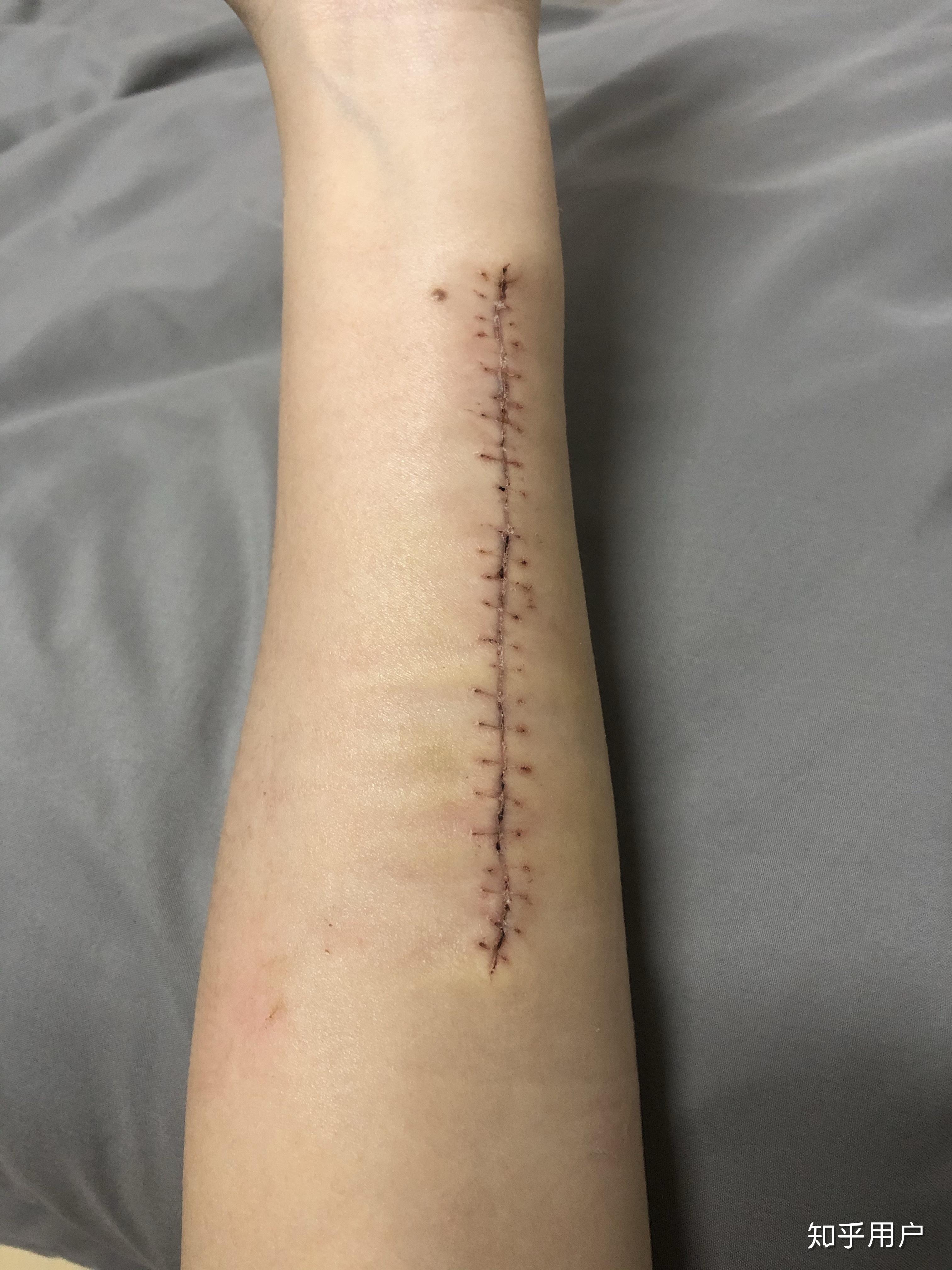 有切除纹身的经验分享吗