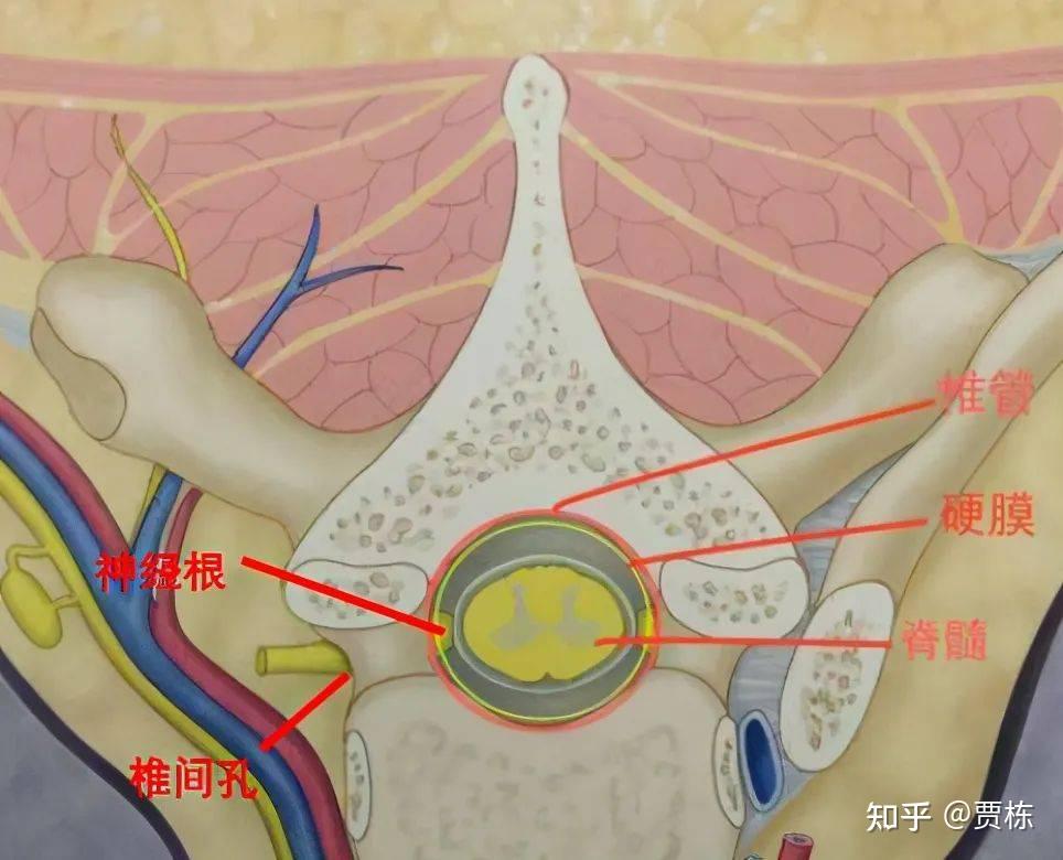 神经鞘瘤示意图图片
