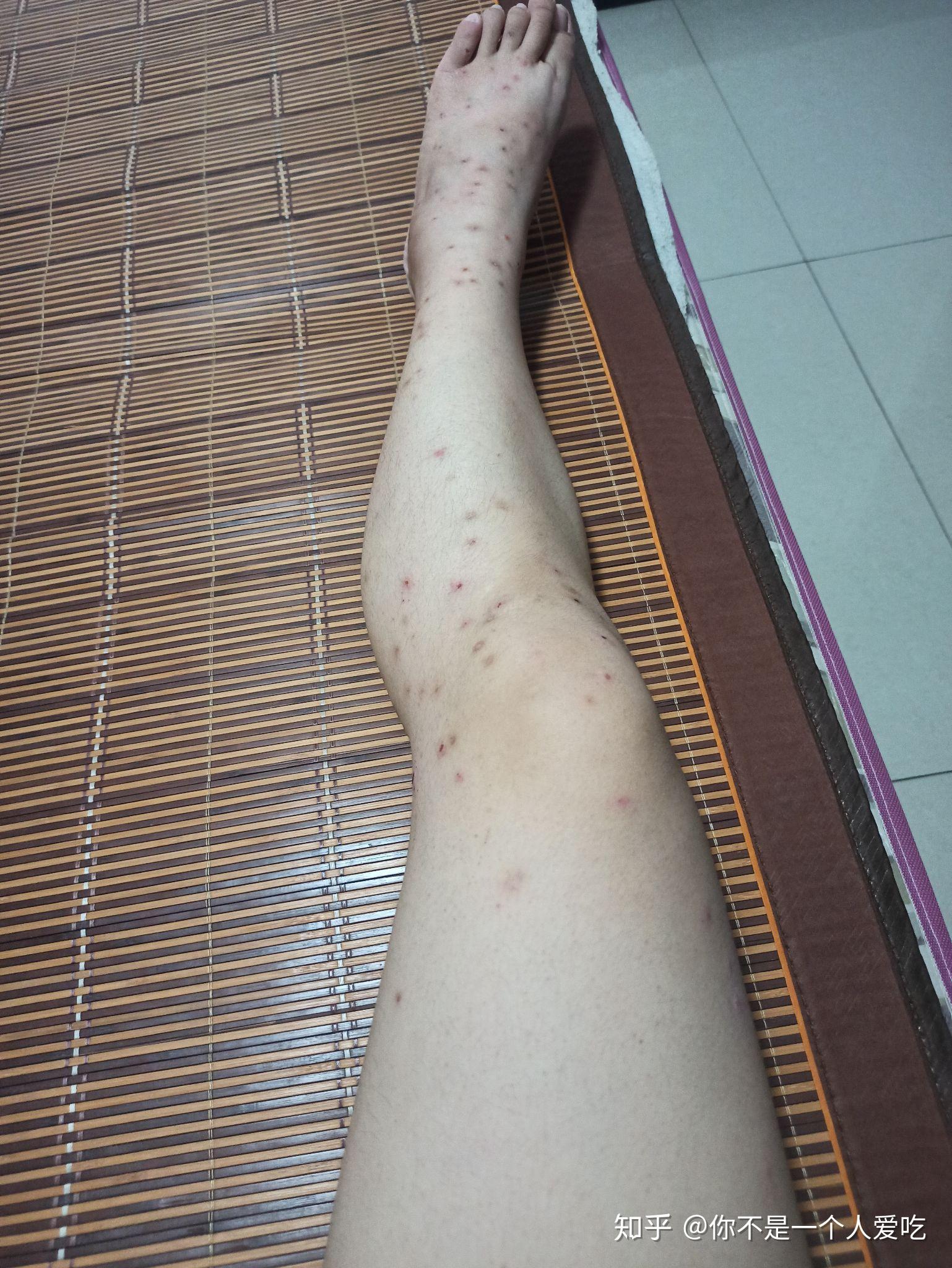 被飞蠓咬了很长时间没好,去了医院也没有很好的效果,有没有好的解决