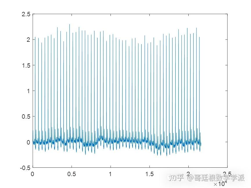心电图v1导联呈rs波,具体的r波代表什么?