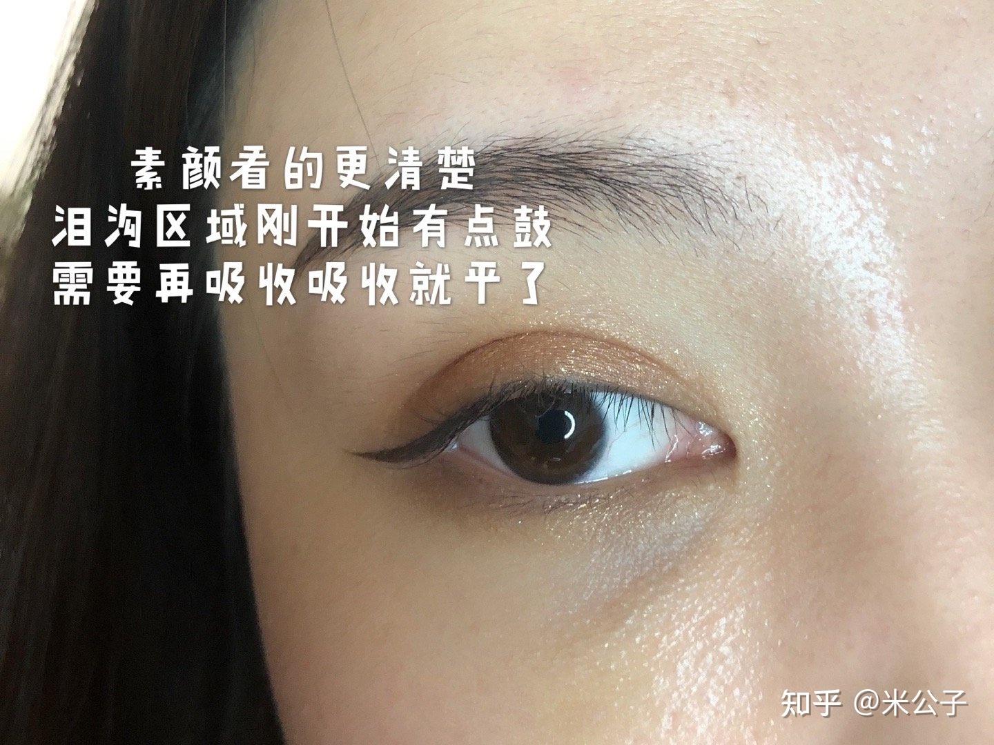 大型真香现场:玻尿酸填充泪沟前后全方位对比! - 知乎