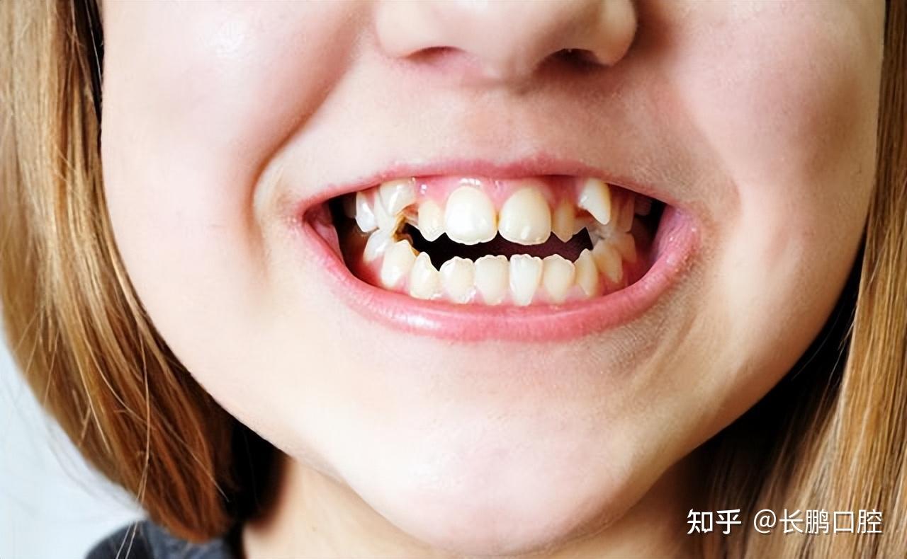 错牙合畸形，如何区分是骨性、牙性还是功能性？_深圳爱康健口腔医院(官网)