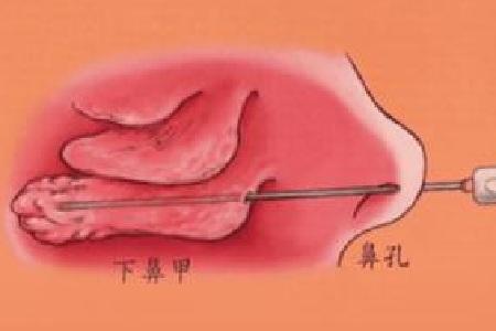 首大崔付军:鼻甲肿大最快消肿的方法