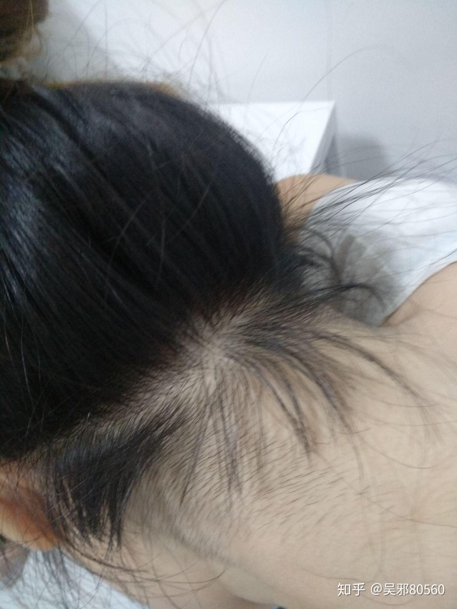 头发都长到脖子上去了,扎起来太难看了,有什么办法去掉这些头发吗?