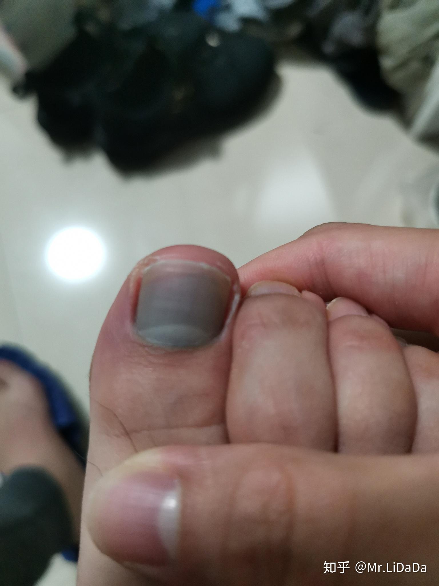 打篮球脚趾甲里面有淤血? - 知乎