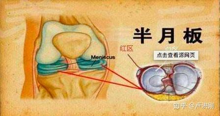 膝蓋的韌帶半月板損傷如何調養適合運動嗎