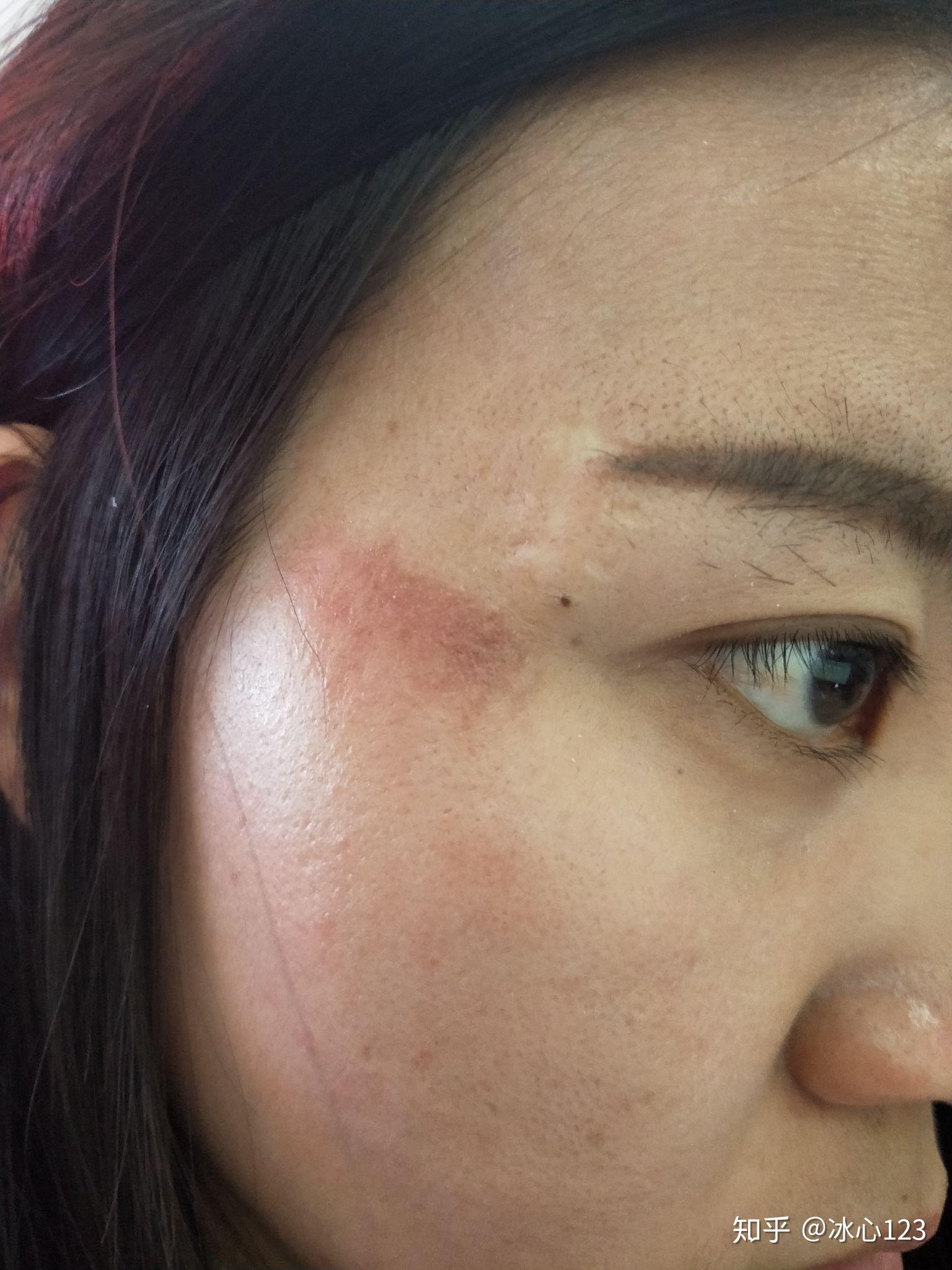脸部擦伤如图请问如何恢复