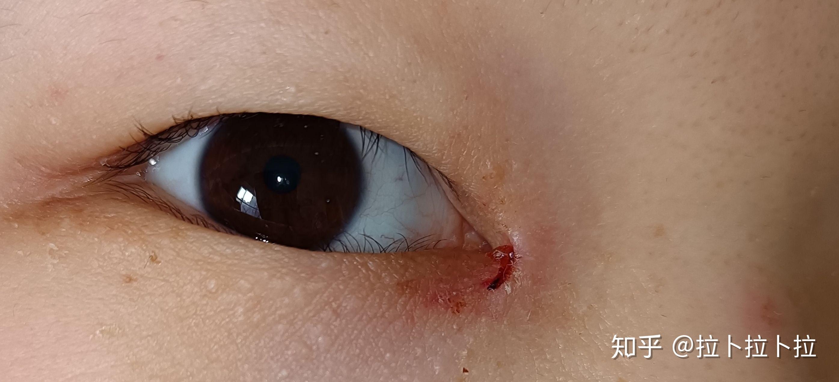 双眼皮拆线后眼角裂开怎么办