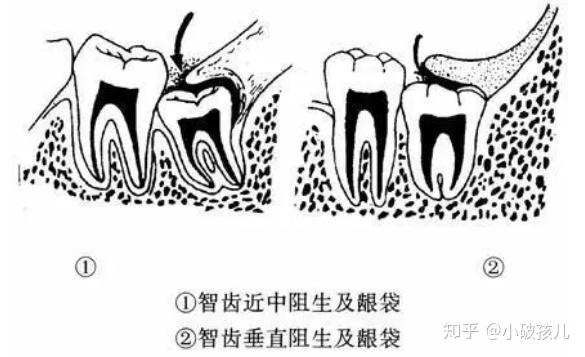 封齿冠揣炎灶指蚤结葛讼方乞(图2)