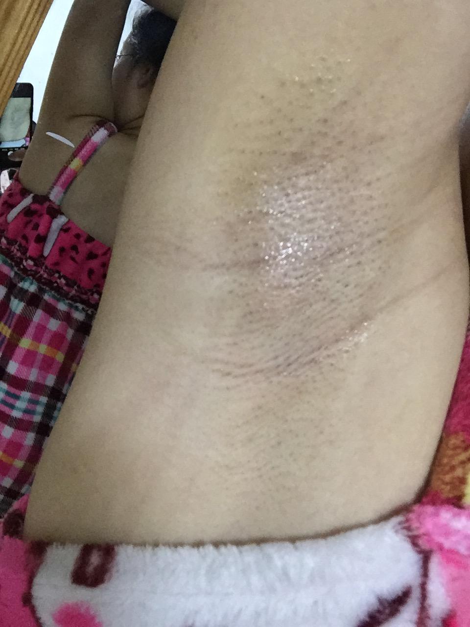 双冰点脱毛说能永久脱毛安全吗有木有副作用对身体有伤害吗真的不会再