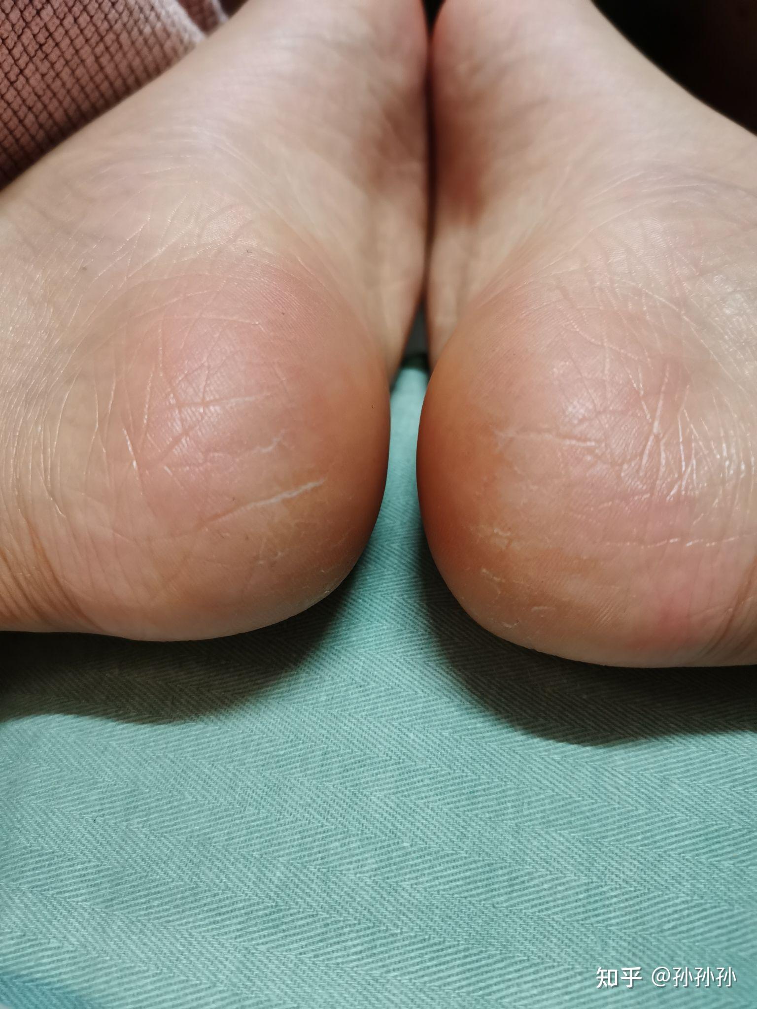 脚后跟裂口是什么原因?脚裂裂口子怎么回事? - 知乎