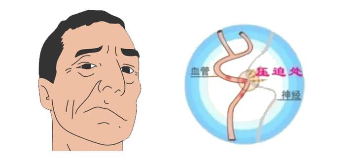 面部抽搐如何鉴别是面肌痉挛? - 知乎