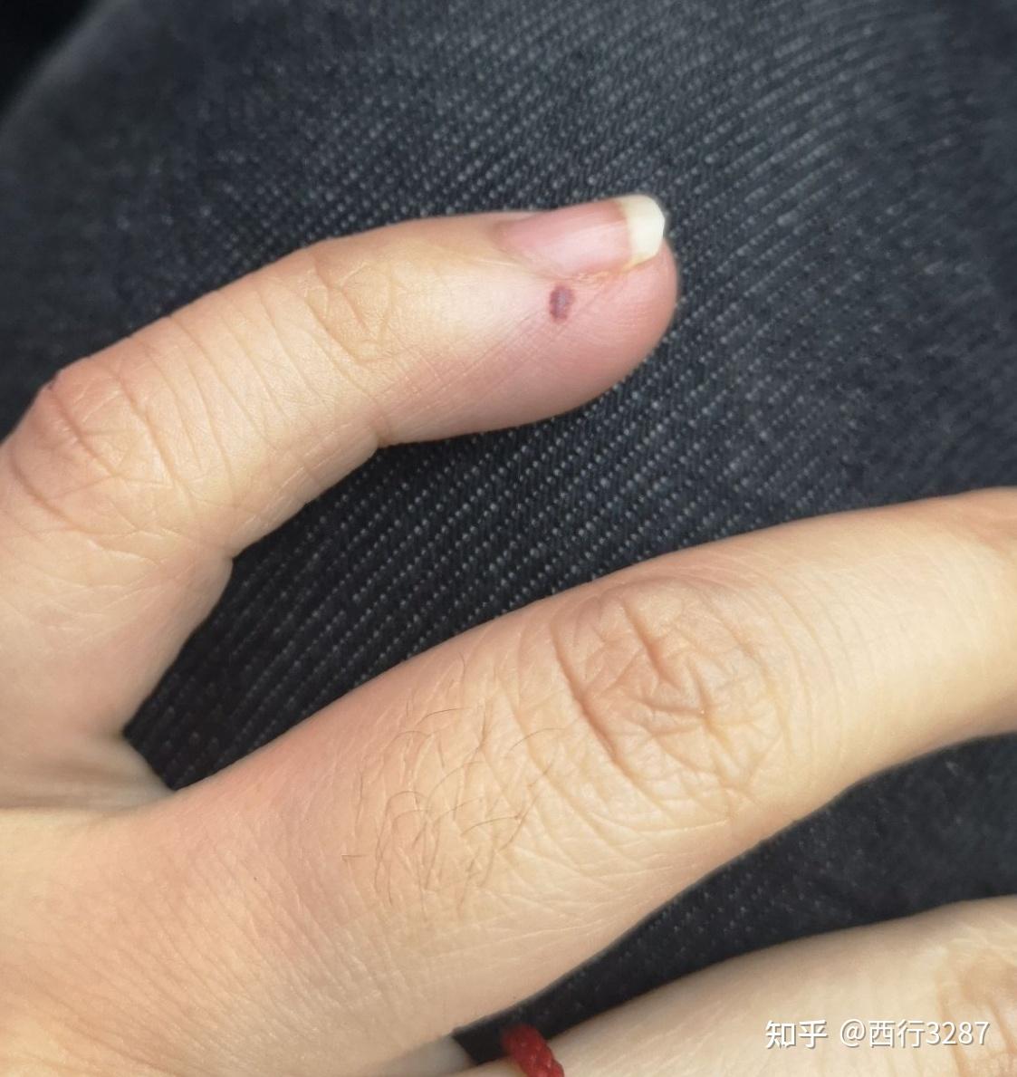 打篮球被砸到手指指腹有淤血如何处理