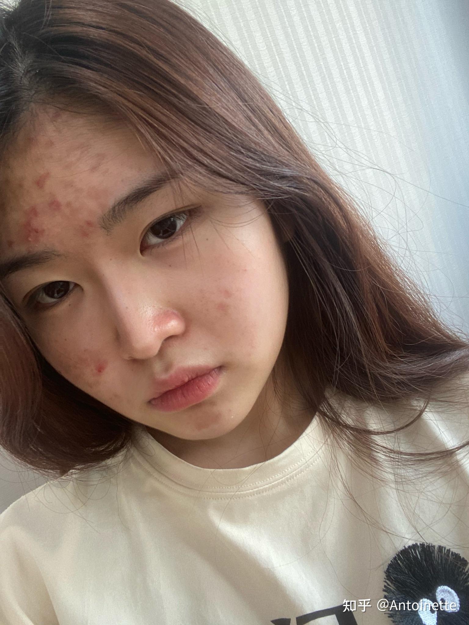 长痘痘的女孩子是不是会没有男孩子喜欢 我好自卑? - 知乎