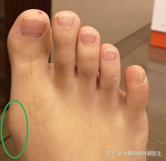 你们的大脚趾都长的什么样