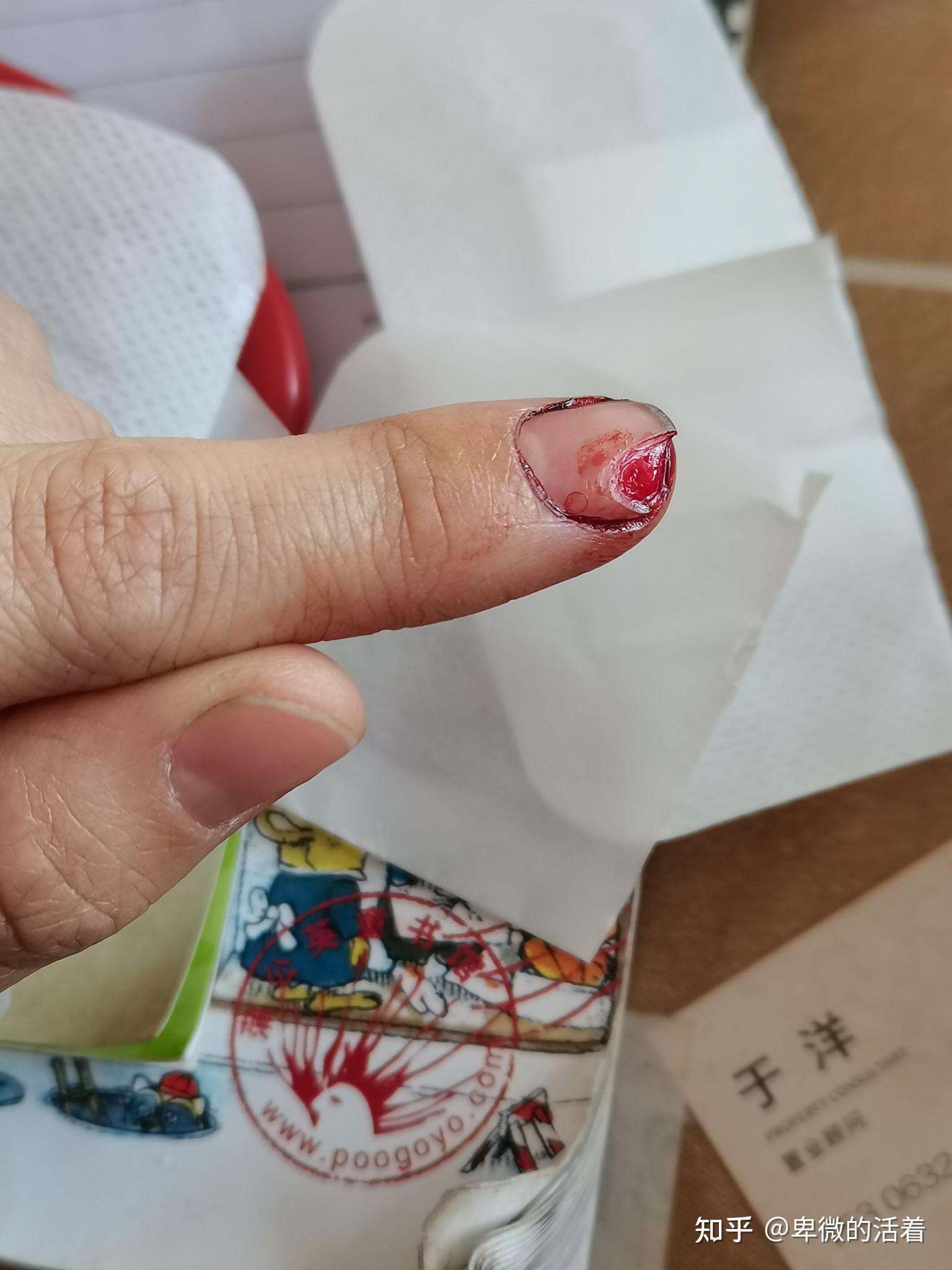 指甲断了还能长出来吗? - 知乎