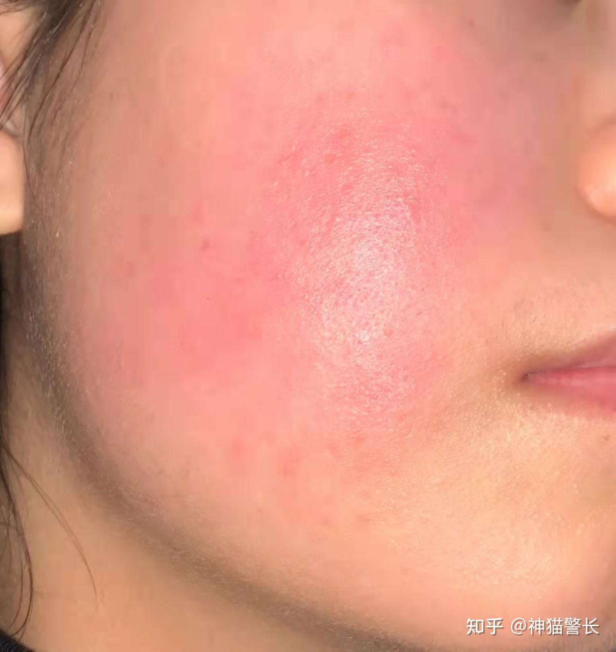 受损的皮肤屏障真的可以修复好吗? - 知乎