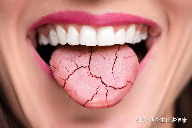 舌体胖大有齿痕，是气堵住了，分享一个中成药，排浊气，健脾补脾 - 知乎