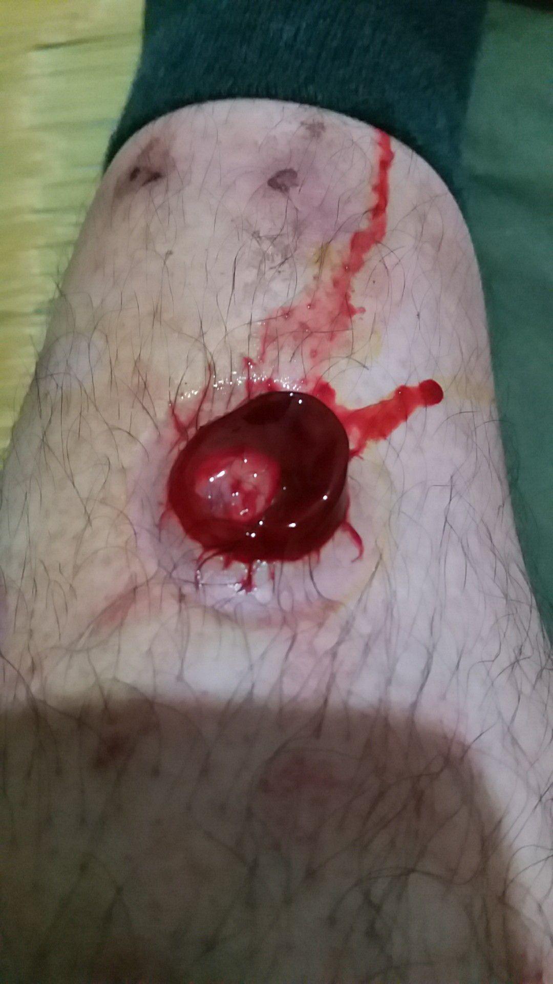 用梅花针拔气罐法从血液中出来的果冻状的东西是什么