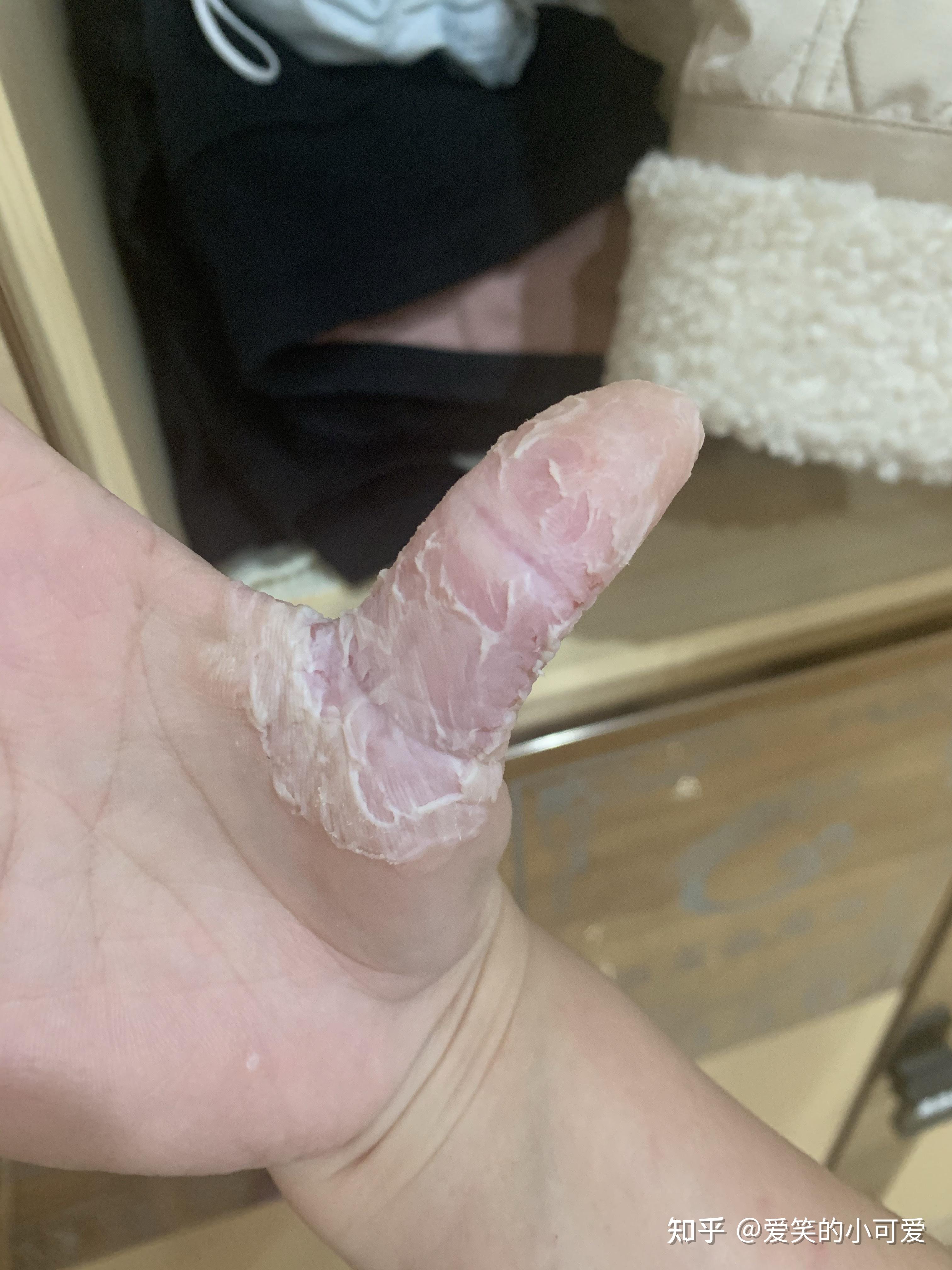 如何控制不自觉的没完没了的撕手皮?如何恢复手指皮肤的状态?