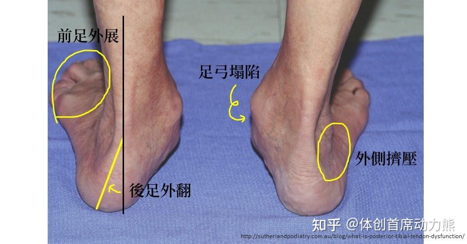 后天性足弓塌陷可以恢复吗,怎么恢复? - 知乎