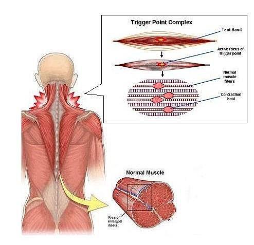 腰酸背痛小心腰肌筋膜炎!康复方案看这儿