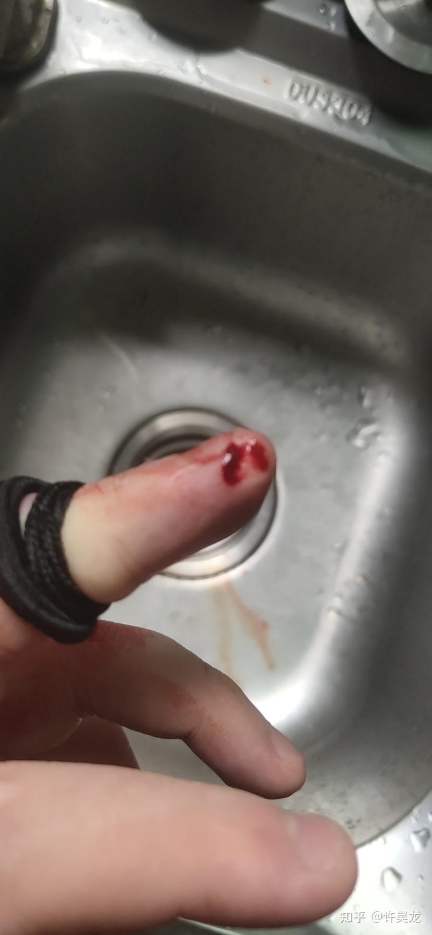 切菜切到手该怎么办? - 知乎