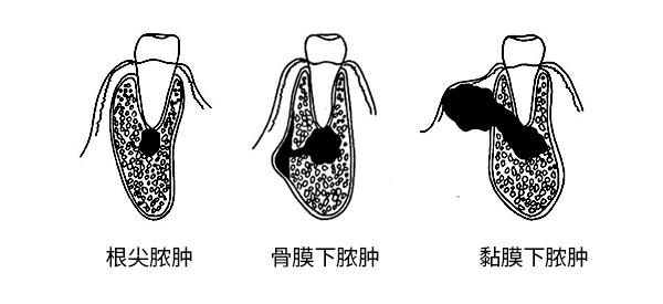 急性根尖周炎各阶段的表现有哪些？ - 知乎