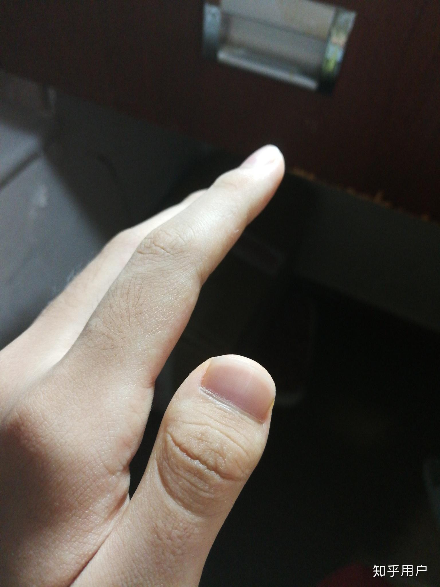 大拇指短甲症图片