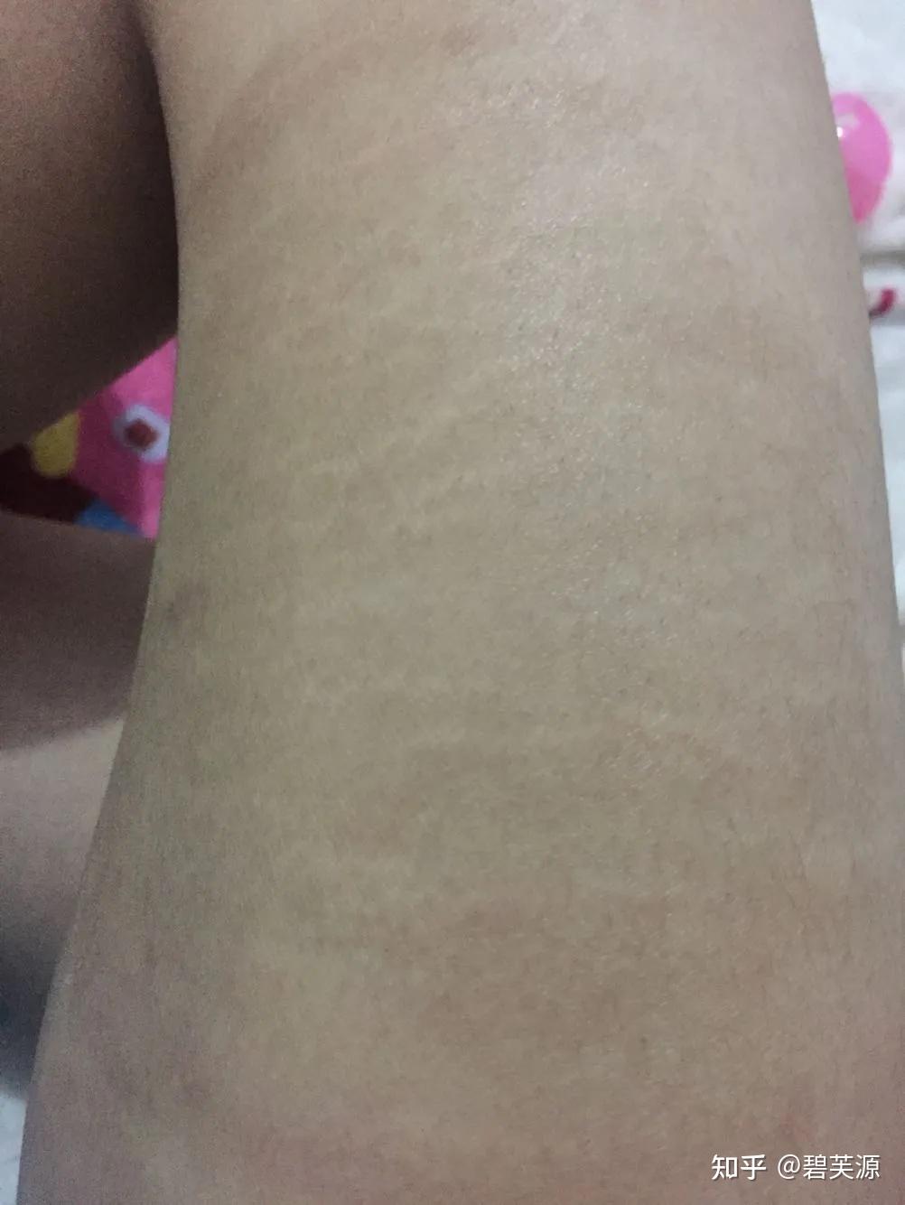 大腿有白色的肥胖纹要怎么去除?