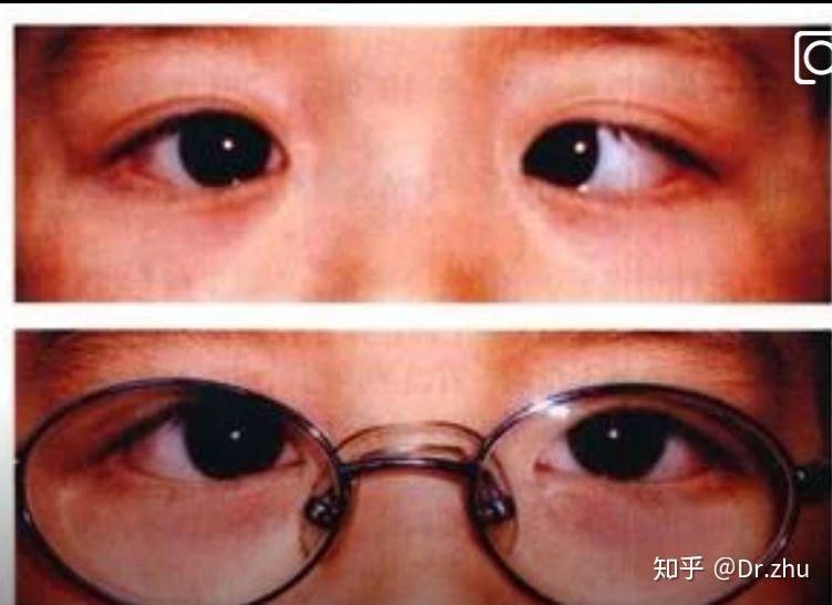 斗鸡眼即对眼除了手术治疗还有哪些方法