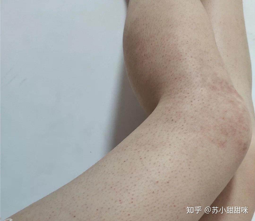 鸡皮肤严重怎么治疗