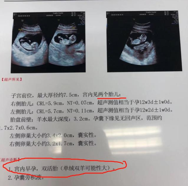67又惊又喜,nt检查发现是双胞胎