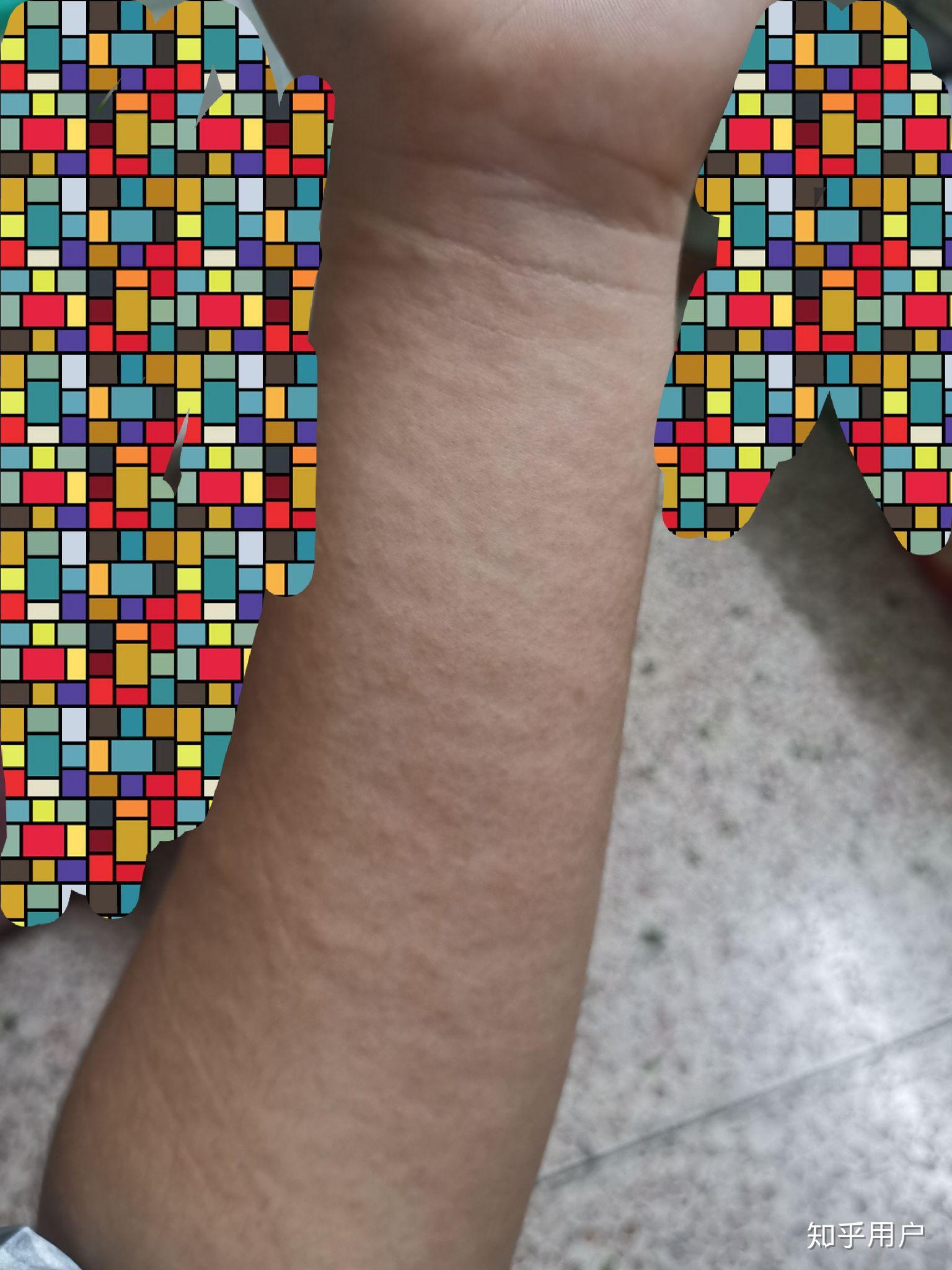 酒精过敏的人喝多了会怎么样