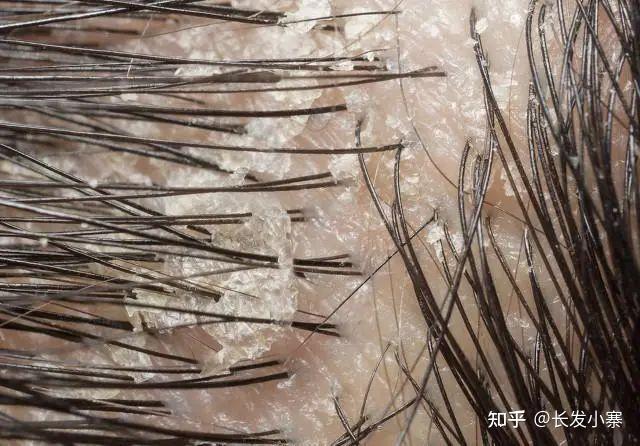 长发小寨-头油头屑头痒,你不得不知道的问题! - 知乎