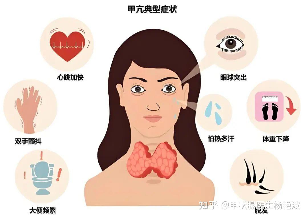 甲亢是什么?你想知道的都在这里,看这一篇就够了! - 知乎