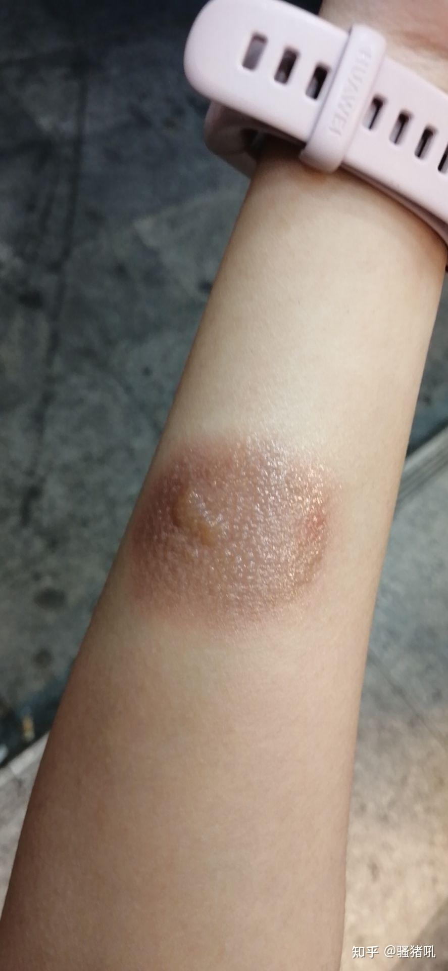 手被水蒸气烫伤怎么处置