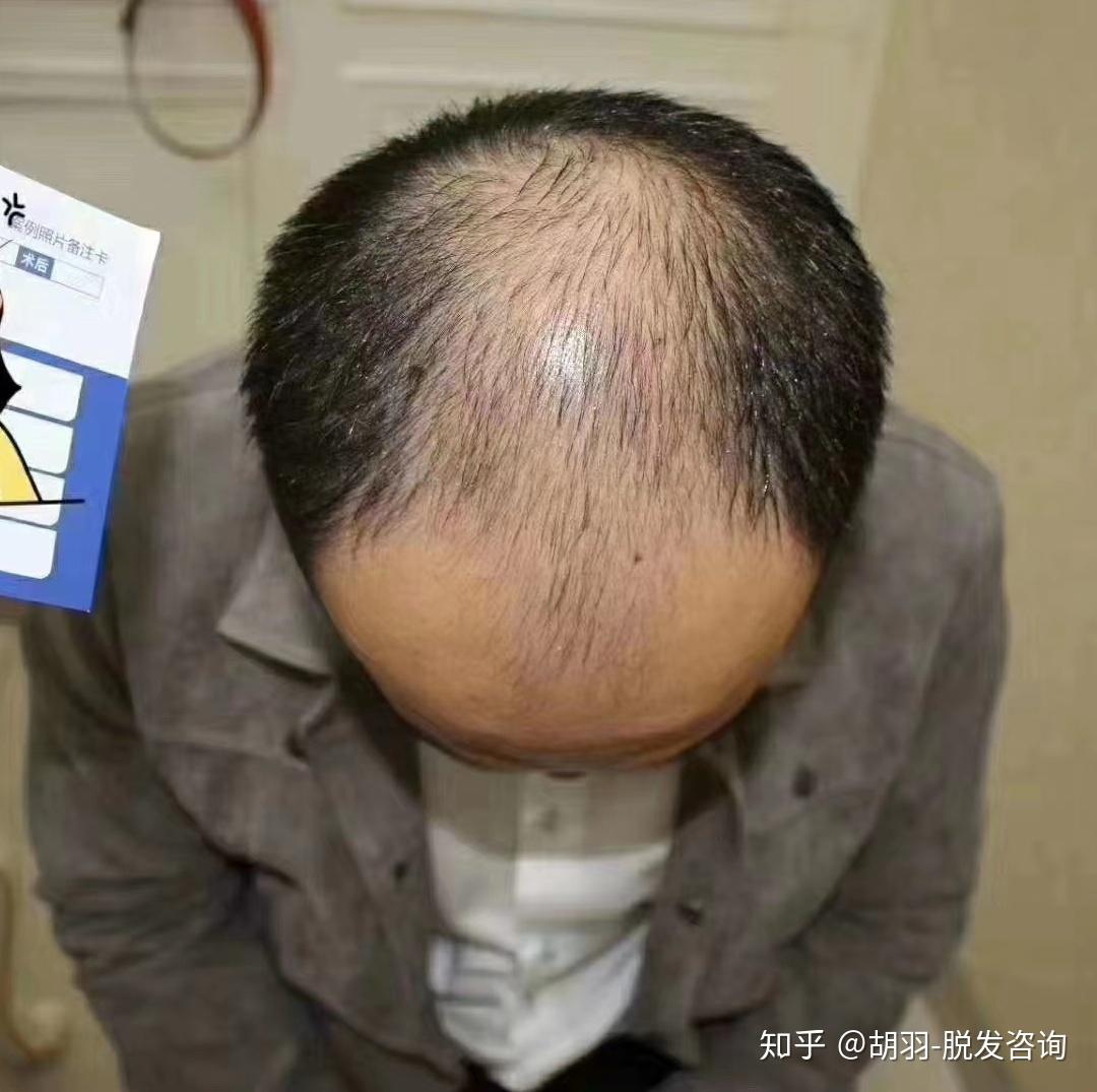 30岁男人脱发严重是该剃光头还是戴假发