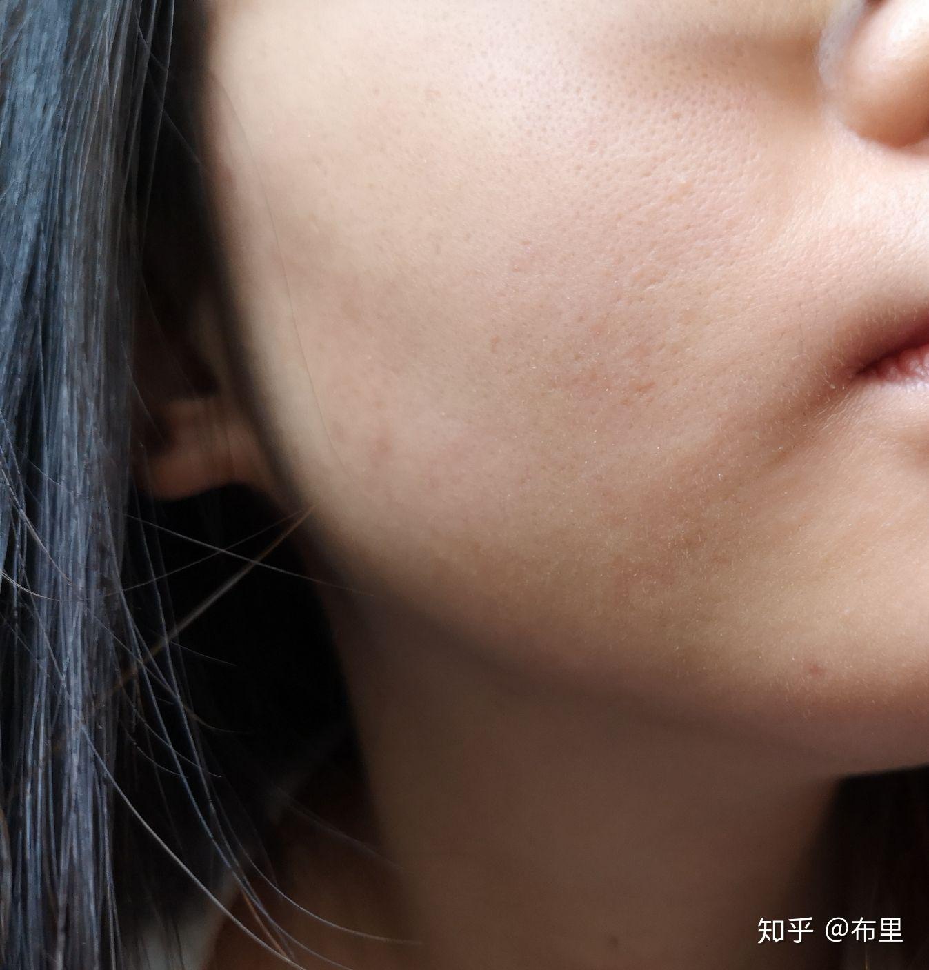口周炎唇炎怎么才能治得好啊？ - 知乎