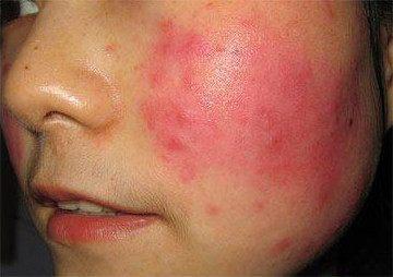 脸上红血丝怎么修复好?