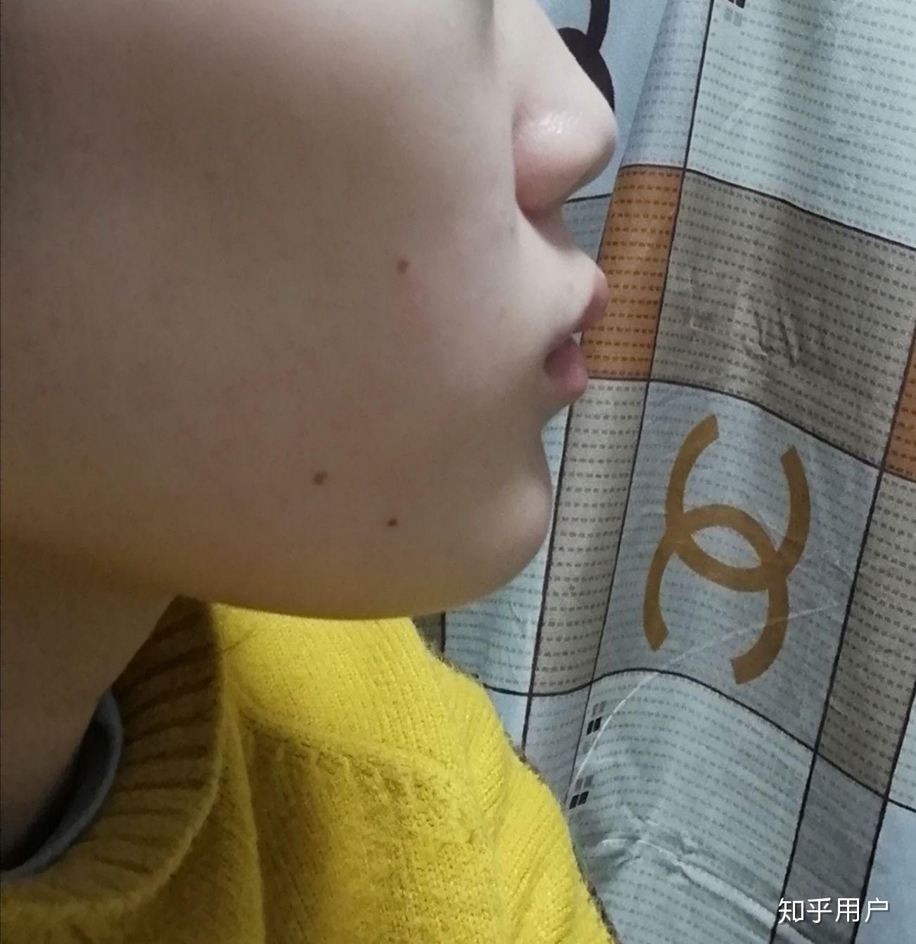 上嘴唇上翘,上翻怎么办?侧面看起来简直丑哭我! - 知乎