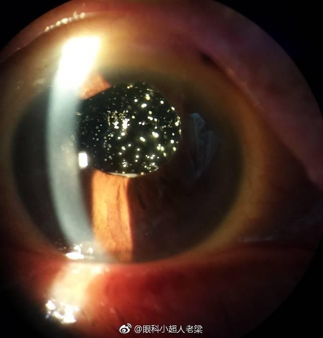 玻璃体变性引起的玻璃体混浊出现的飞蚊症能好吗? - 知乎