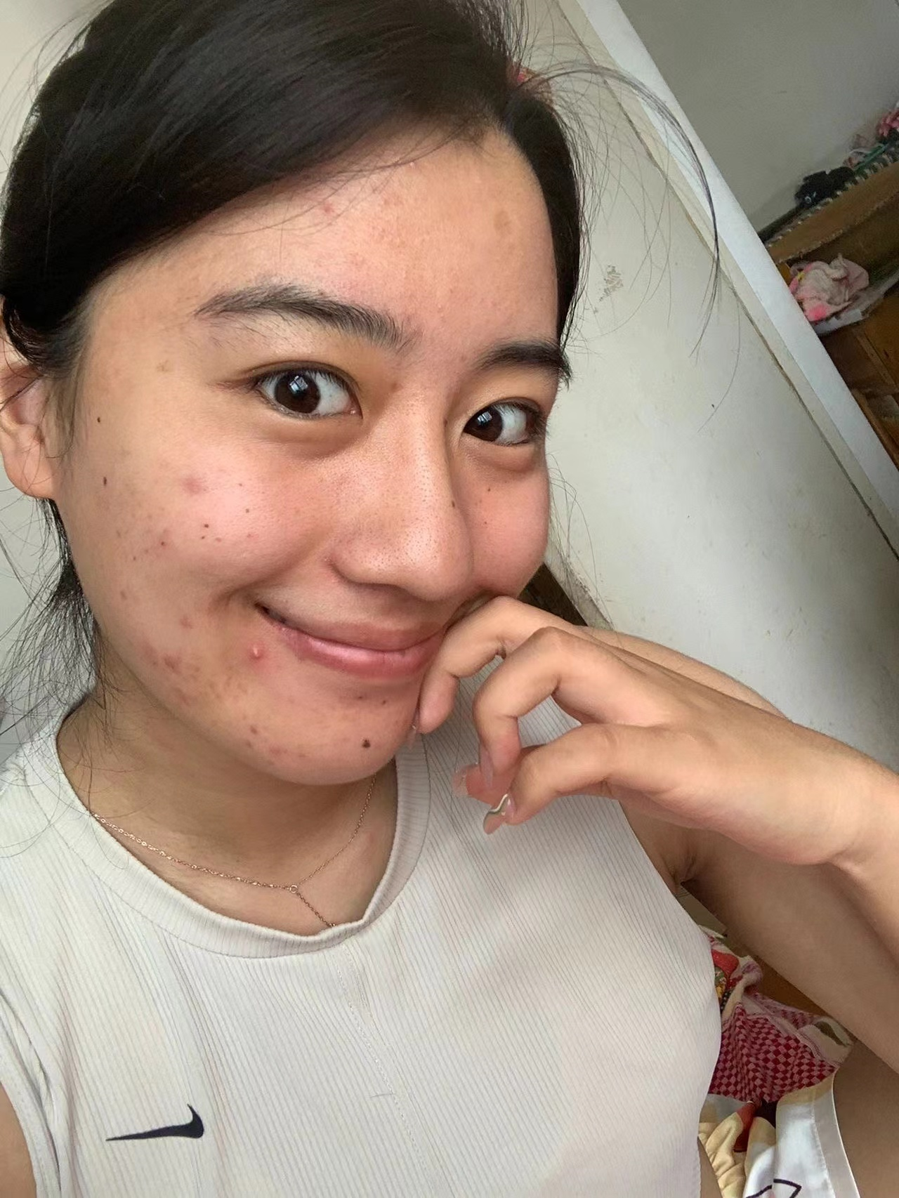 脸上长期长痘痘是什么原因 v2-76a40901e547cb86b01fb76fe6137000_r.jpg