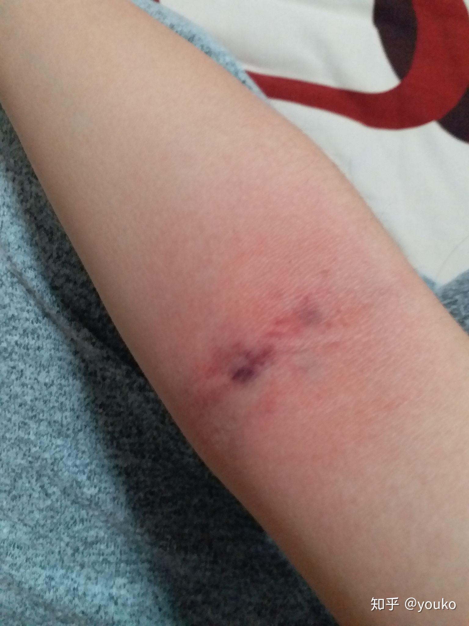 拍打手肘窝真的可以排毒吗