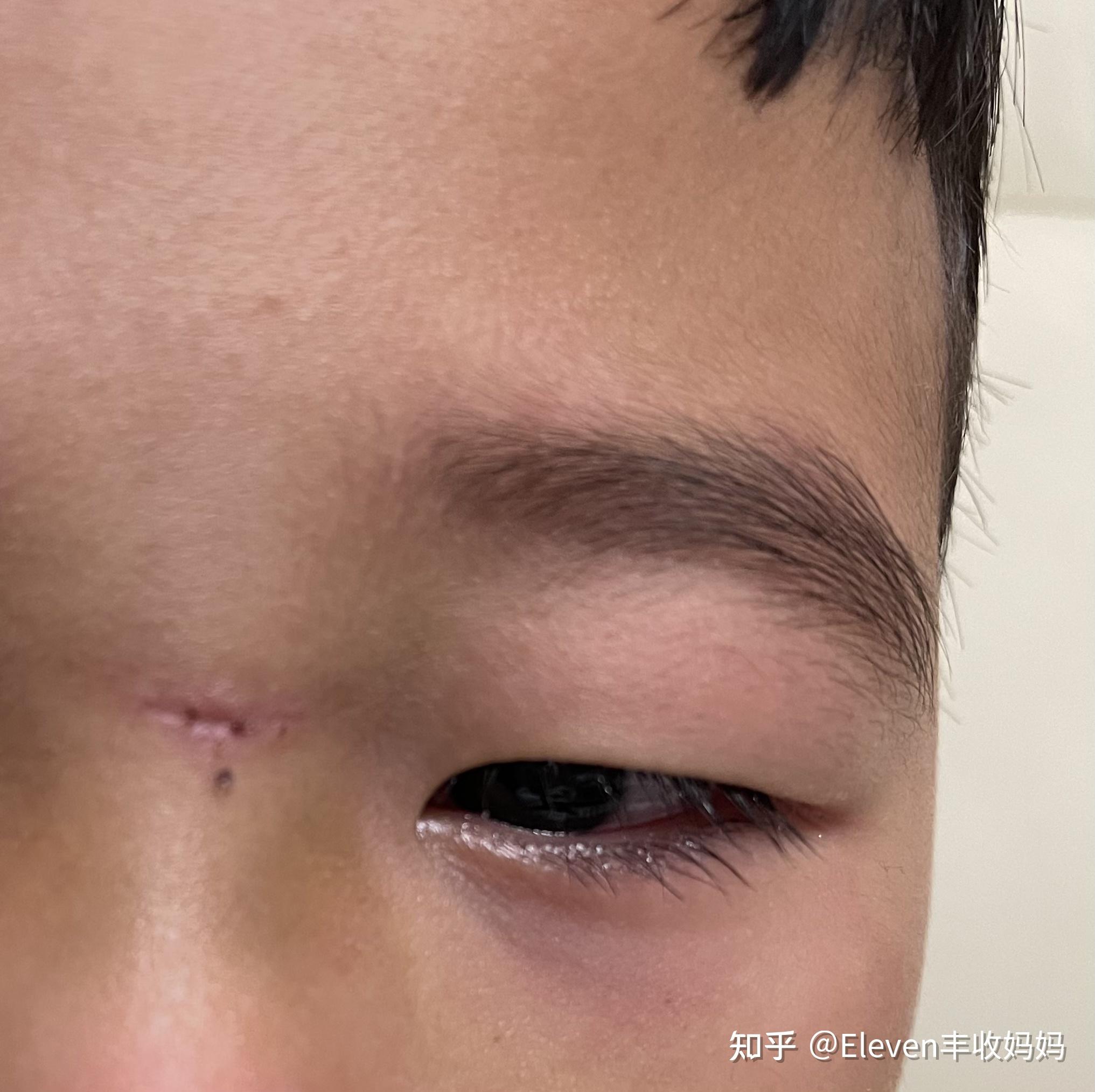 脸上缝针疤痕怎么去除? - 知乎