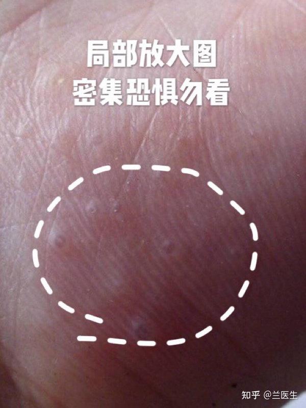 汗疱疹最简单的自愈方法? - 知乎