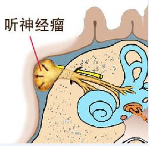 怎么做才会导致听力下降 v2-777dc8103add50345334928d2be46e61_1440w.jpg?source=172ae18b