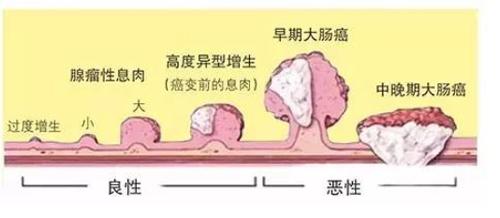 医生提醒 肠息肉切除术后 做好这几件小事 以更快恢复健康 知乎