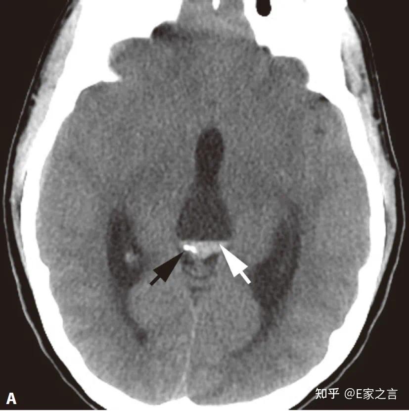 脑ct显示松果体囊性病变是什么意思