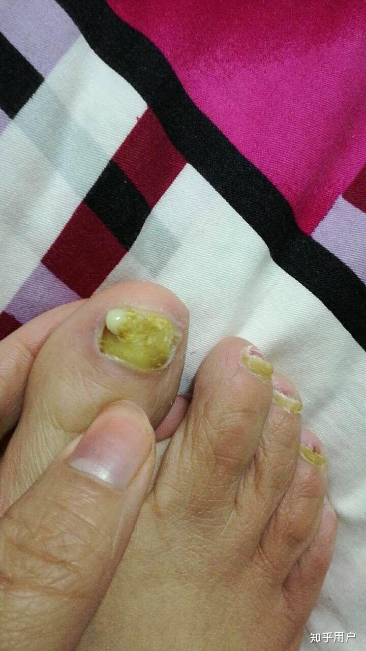 脱甲精油对灰指甲有用吗?